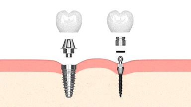 Odontología Cosmética en Lake City, FL Dentista Aspire Dental Group - Mini Implantes Dentales