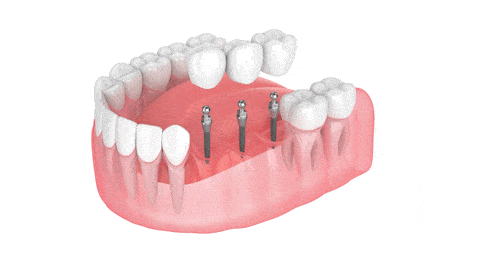Puentes dentales en Lake City Puente de implantes Aspire Dental Group