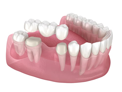 Puentes dentales en Lake City Puente de implantes Aspire Dental Group