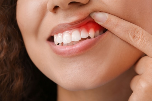 Gum Disease Treatment in Lake City, FL Aspire Dental Group