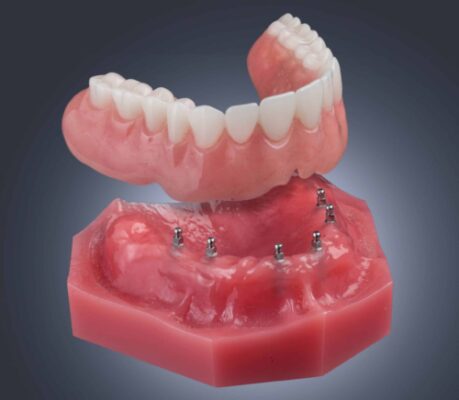 Implantes Dentales en Lake City FL Dr. Robert Harvey Aspire Dental Group