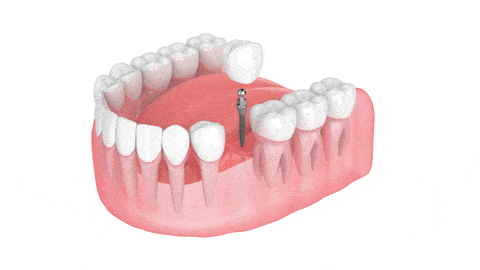 Mini Implantes Dentales en Lake City, FL Aspire Dental Group