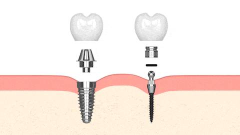 Mini Dental Implants vs. Traditional Implants in Lake City, FL