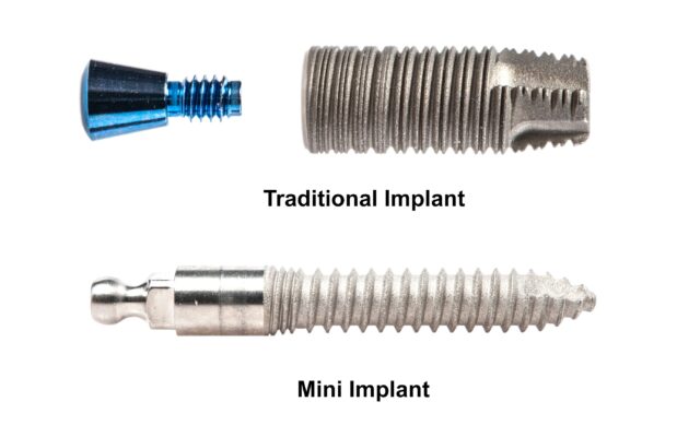 Tipos de implantes dentales | Aspire Dental Group
