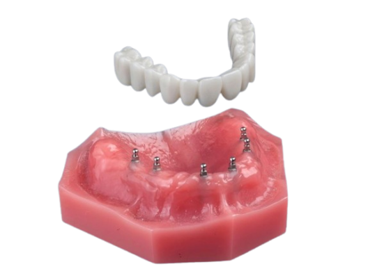 Mini Dentaduras en Lake City, FL | Implantes Dentales | Opciones de Dentaduras